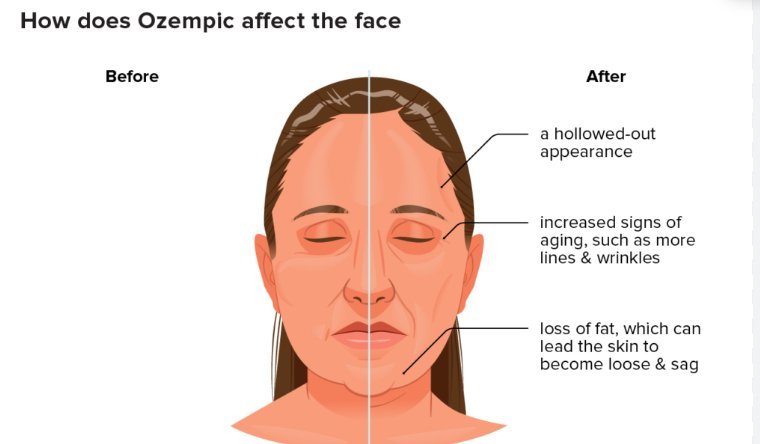 Ozempic & Collagen - AletaCollagen
